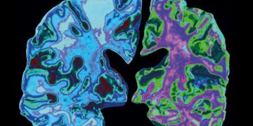 Alzheimer’s Study: A Mediterranean diet might reduce the danger of dementia.