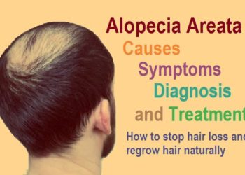 Everything you need to know about Alopecia areata: