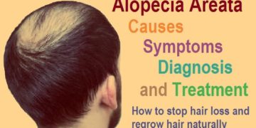 Everything you need to know about Alopecia areata: