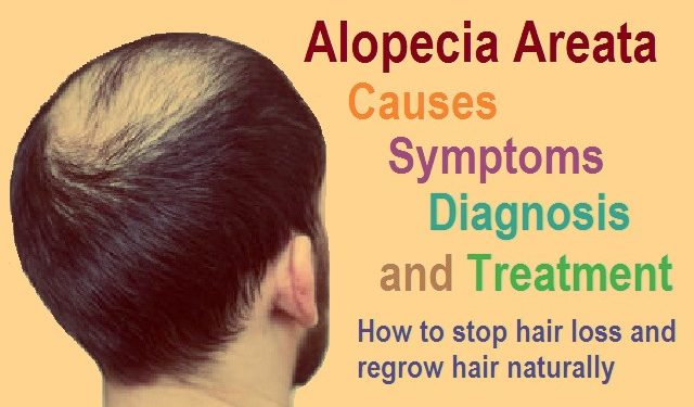 Everything you need to know about Alopecia areata: