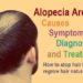 Everything you need to know about Alopecia areata: