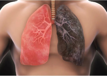 Everything You Need To Know About lung cancer- Overview, Symptoms, and Treatment
