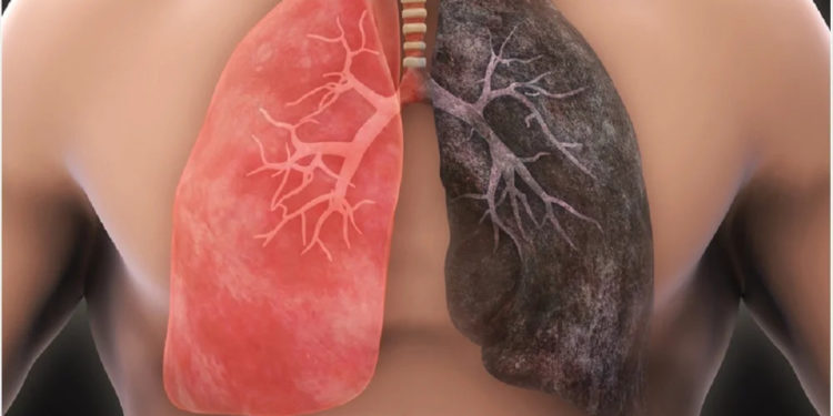 Everything You Need To Know About lung cancer- Overview, Symptoms, and Treatment