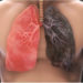 Everything You Need To Know About lung cancer- Overview, Symptoms, and Treatment