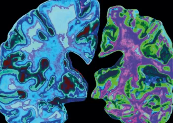 Alzheimer's disease: First drug that shows destruction of brain in Alzheimer's ' Momentous'