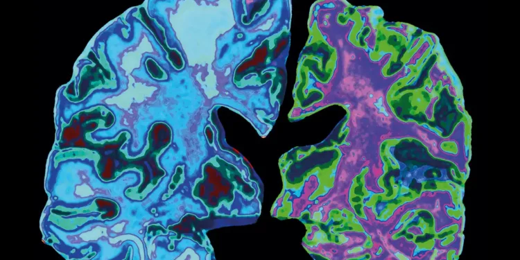 Alzheimer's disease: First drug that shows destruction of brain in Alzheimer's ' Momentous'